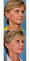 55-64 Year Old Woman Treated With Facelift By Dr Louis P. Bucky, MD, Philadelphia Plastic Surgeon
