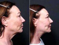 55-64 Year Old Woman Treated With Facelift By Dr Remus Repta, MD, Scottsdale Plastic Surgeon