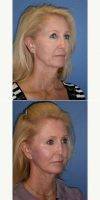 55-64 Year Old Woman Treated With Facelift By Dr. Burr Von Maur, MD, Orange County Plastic Surgeon