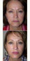 55-64 Year Old Woman Treated With Facelift By Dr. Hayley Brown, MD, FACS, Las Vegas Plastic Surgeon