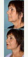 55-64 Year Old Woman Treated With Facelift - Upper And Lower Blepharoplasty With Dr Jose Perez-Gurri, MD, FACS, Miami Plastic Surgeon