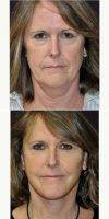 55-64 Year Old Woman Treated With Facelift With Doctor Paul G. Gerarchi, MBBS, FRACS, Sydney Facial Plastic Surgeon