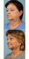 55-64 Year Old Woman Treated With Facelift With Dr Suzanne Yee, MD, Little Rock Facial Plastic Surgeon