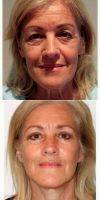 55-64 Year Old Woman Treated With Facelift With Dr. Damien Grinsell, MBBS, FRACS (Plast), Melbourne Plastic Surgeon