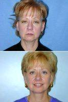 55 Year Old Woman Who Was Unhappy With Her Appearance By Doctor Lewis Ladocsi, MD, FACS, Richmond Plastic Surgeon