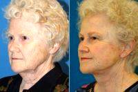 Doctor George Yang, MD, New York Facial Plastic Surgeon - Lower Facelift And Necklift With Platysmaplasty