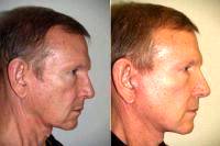 Doctor Jeffrey Epstein, MD, FACS, Miami Facial Plastic Surgeon - Facelift With Necklift