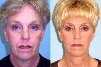 Doctor John Cassel, MD, Miami Plastic Surgeon Before And After