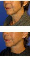 Dr. Raymond E. Lee, MD, Orange County Facial Plastic Surgeon 51 Year Old Woman Treated With Facelift