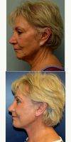 Dr. Richard G. Reish, MD, New York Plastic Surgeon 65-74 Year Old Woman Treated With Facelift