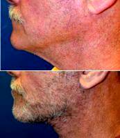 Dr. Sanaz Harirchian, MD, Houston Facial Plastic Surgeon - 66 Year Old Male 2 Weeks After Facelift & Necklift