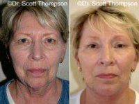 Dr. Scott K. Thompson, MD, Salt Lake City Facial Plastic Surgeon - 66 Year Old Female With Facelift