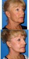 Dr. Stephen Prendiville, MD, Fort Myers Facial Plastic Surgeon 65-74 Year Old Woman Treated With Facelift