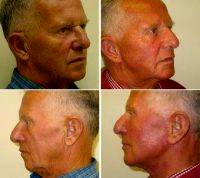Dr. Thomas Buonassisi, MD, Vancouver Facial Plastic Surgeon - Facelift Before & After Photos