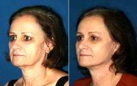 Face And Neck Lift By Dr. Gregory Park, MD, San Diego Plastic Surgeon