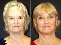 Face Neck Lift Patient - Before & After Photos. By Doctor Leonard Hochstein, MD, Miami Plastic Surgeon