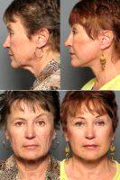 Facelift & Brow Lift With Dr Adam D. Stein, MD, Raleigh-Durham Facial Plastic Surgeon