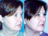 Facelift By Doctor Andrew Miller, MD, Edison Facial Plastic Surgeon