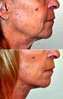 Facelift By Doctor Barry L. Eppley, MD, DMD, Indianapolis Plastic Surgeon