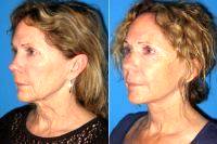 Facelift By Dr Alyson Wells, MD, FACS, Baltimore Plastic Surgeon