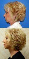 Facelift By Dr Paul S. Gill, MD, Houston Plastic Surgeon