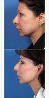 Facelift, Neck Lift Surgery By Doctor John M. Hilinski, MD, San Diego Facial Plastic Surgeon
