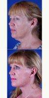 Facelift, Upper Blepharoplasty By Dr. Michael Boggess, MD, Nashville Facial Plastic Surgeon