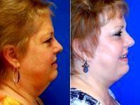 Facelift With An Extended SMAS Flap By Dr. Randy Proffitt, MD, Mobile Plastic Surgeon