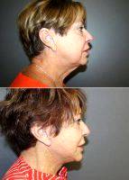 Facelift With Dr Shelby Brantley, MD, Jackson Plastic Surgeon