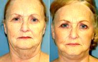 Facelift With Dr Stephen E. Zucker, MD, South Bend Plastic Surgeon