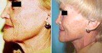Female Patient Who Underwent A Facelift With Dr. Steven M. Lynch, MD, Albany Plastic Surgeon