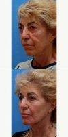 Lady Treated For Her Second Facelift By Dr. Frank P. Fechner, MD, Worcester Facial Plastic Surgeon