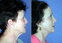 Neck Lift Surgery With Doctor Tom J. Pousti, MD, FACS, San Diego Plastic Surgeon