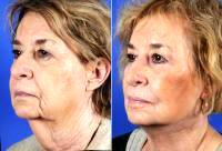 Procedures Full Face – Neck Lift, Submentoplasty, Full Face Fat Transfer, Lower Blepharoplasty With Dr Mario J. Imola, MD, DDS, Denver Facial Plastic Surgeon