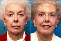 SMAS Facelift Necklift Browlift Upper Blepharoplasty Chin Implant With Doctor Richard H. Tholen, MD, FACS, Minneapolis Plastic Surgeon