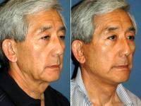 Signature Facelift On A Man By Dr Michael R. Menachof, MD, Greenwood Village Facial Plastic Surgeon