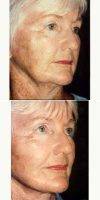 Woman Treated With Facelift By Doctor Jon F. Harrell, DO, FACS, Miami Plastic Surgeon