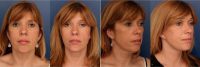 54 Year Old Woman Treated With Facelift Before By Doctor Ronald Schuster, MD, Baltimore Plastic Surgeon