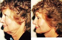 54 Year Old Woman Treated With Facelift Before By Dr Thomas A. Narsete, MD, Denver Plastic Surgeon