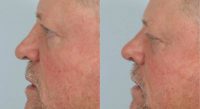 55-64 year old man treated with Revision Rhinoplasty