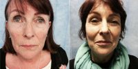 55 Year Old Woman Treated With Facelift Before By Dr. Frank Conroy, MBChB, MRCS, FRCS(Plast), Dubai Plastic Surgeon