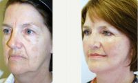57 Year Old Woman Treated With Facelift Before By Dr. Cory Torgerson, MD, PhD, FRCSC, Toronto Facial Plastic Surgeon