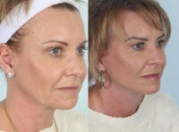 55-64 year old woman treated with Facelift and Platysmal Myectomy