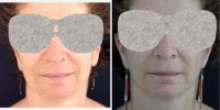 60 Year Old Woman Treated With Facelift Before By Doctor Carolina Restrepo, MD, Colombia Plastic Surgeon