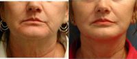 60 Year Old Woman Treated With Facelift Before By Dr. Karol A. Gutowski, MD, FACS, Chicago Plastic Surgeon