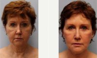 61 Year Old Woman Treated With Facelift, Laser Resurfacing Before With Dr Hampton Alexander Howell, MD, Winston Salem Plastic Surgeon