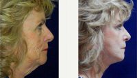 65 Year Old Woman Treated With Facelift Before With Doctor Anna Petropoulos, MD, FRCS, Boston Facial Plastic Surgeon