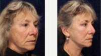 67 Year Old Woman Treated With Facelift Before With Dr Douglas L. Gervais, MD, Minneapolis Plastic Surgeon