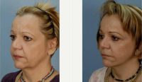 68 Year Old Woman Treated With Facelift, Endoscopic Browlift, Upper And Lower Blepharoplasty Before With Dr. Giancarlo Zuliani, MD, Rochester Facial Plastic Surgeon
