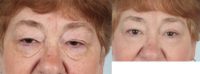 65-74 year old woman treated with Upper eyelid surgery and lower eyelid surgery for festoons